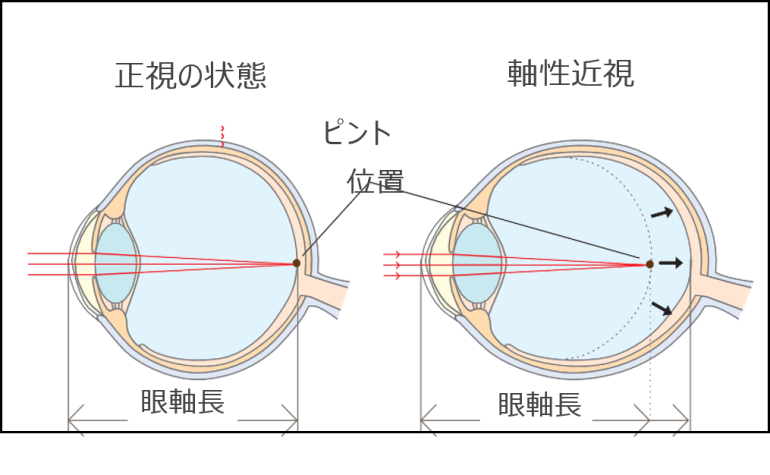 近視について